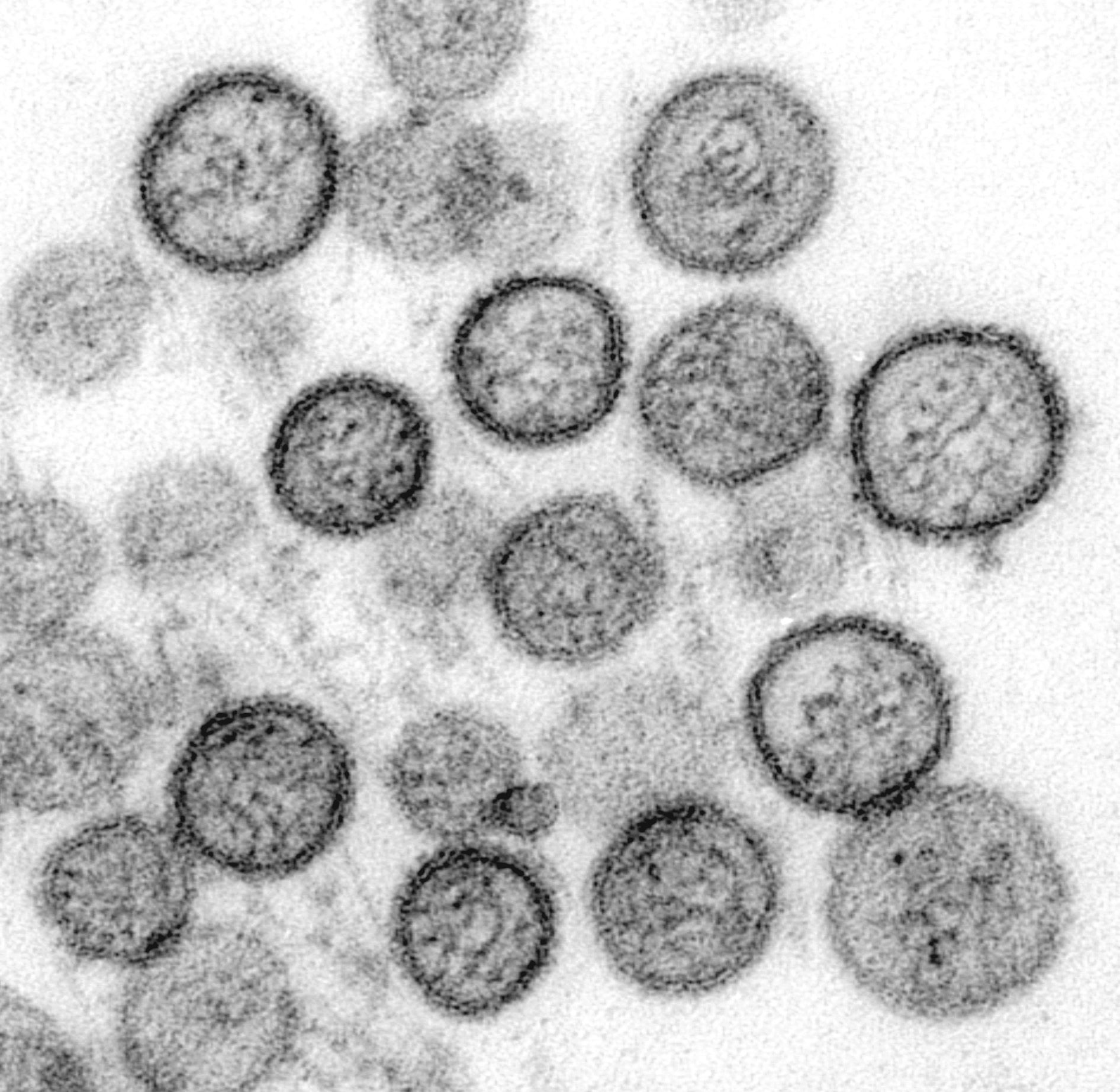 Hantavirus particles under electron microscopy, showing characteristic structure of this rodent-borne pathogen